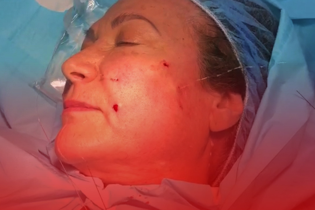 Thread Lift Certificate Course – Practical 