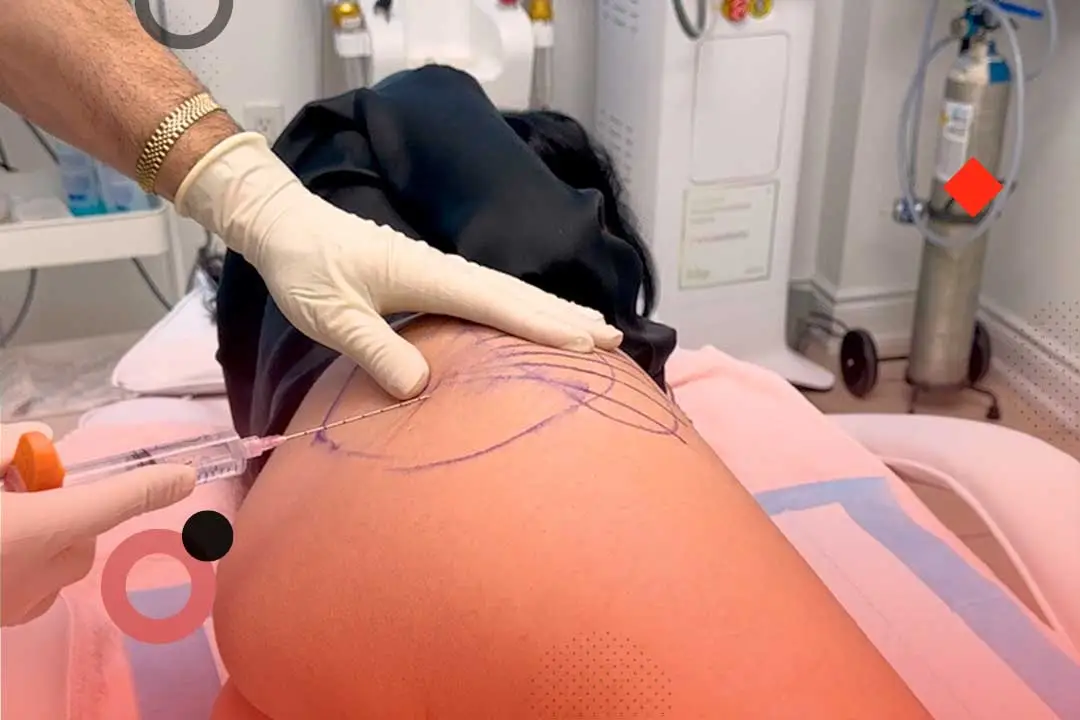 Non-surgical Butt Augmentation (Hands-on) 