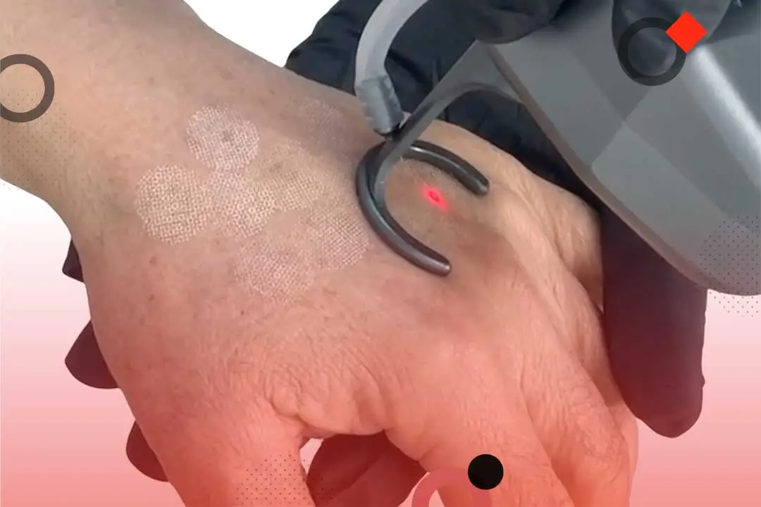 Non-surgical Hand Rejuvenation (Hands-on)